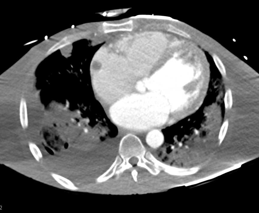Thrombi in the Right Atrium - CTisus CT Scan