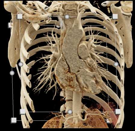 Bicuspid Aortic Valve - CTisus CT Scan