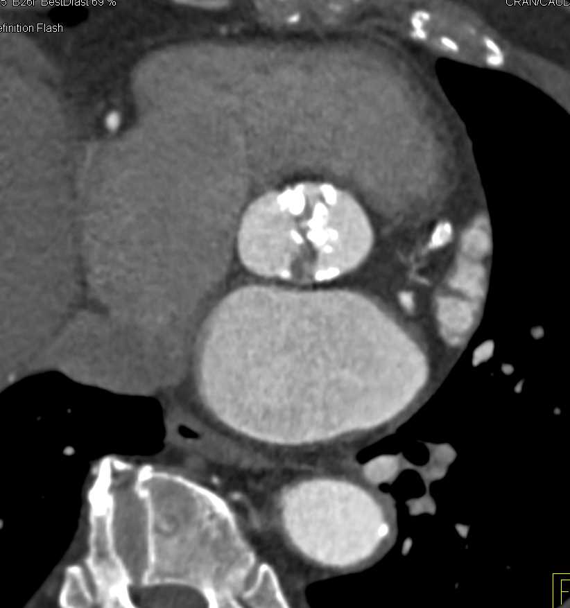 Bicuspid Aortic Valve with Calcifications - CTisus CT Scan