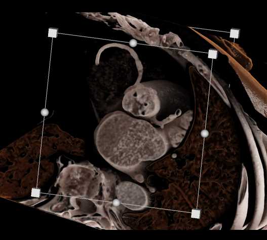Bicuspid Aortic Valve with Calcifications - CTisus CT Scan