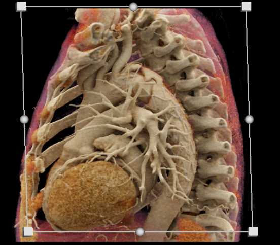 Endovascular Stent Repair with CR Display - CTisus CT Scan