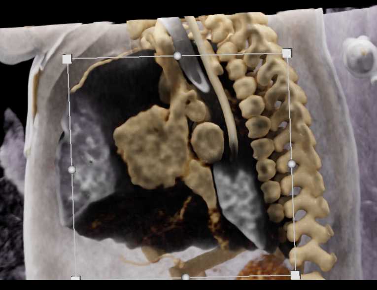 3D Vascular Mapping for Pediatric Vascular Display and Lung Display - CTisus CT Scan