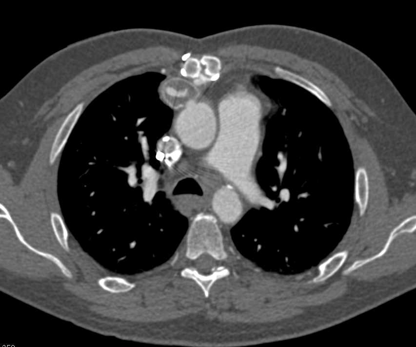 Left Ventricular Assist Device (LVAD) with Thrombus in Line from LV to Aorta - CTisus CT Scan