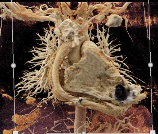 Left Ventricular Assist Device (LVAD) with Thrombus in Line from LV to Aorta - CTisus CT Scan