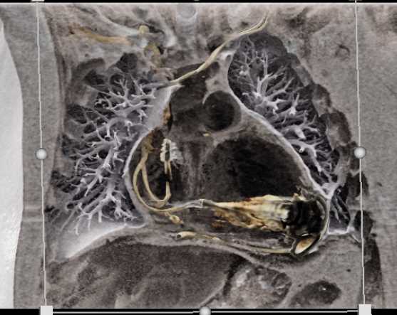 Left Ventricular Assist Device (LVAD) with Thrombus in Line from LV to Aorta - CTisus CT Scan
