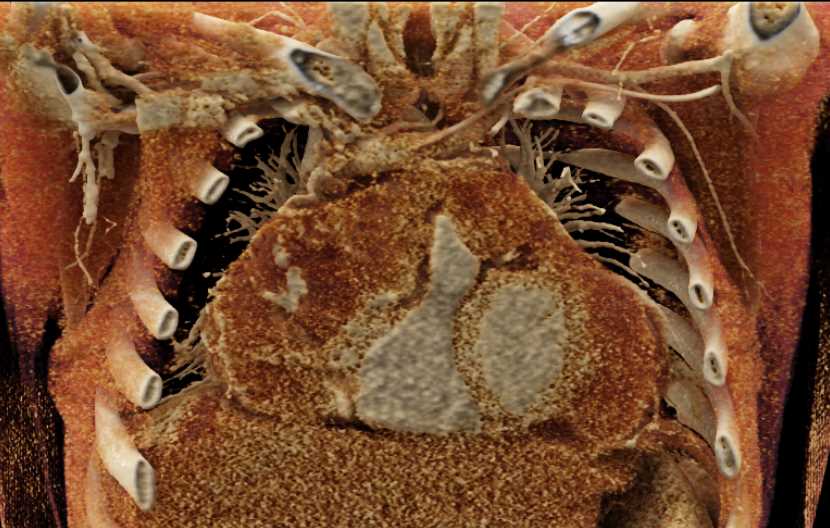 Cardiac Angiosarcoma - CTisus CT Scan