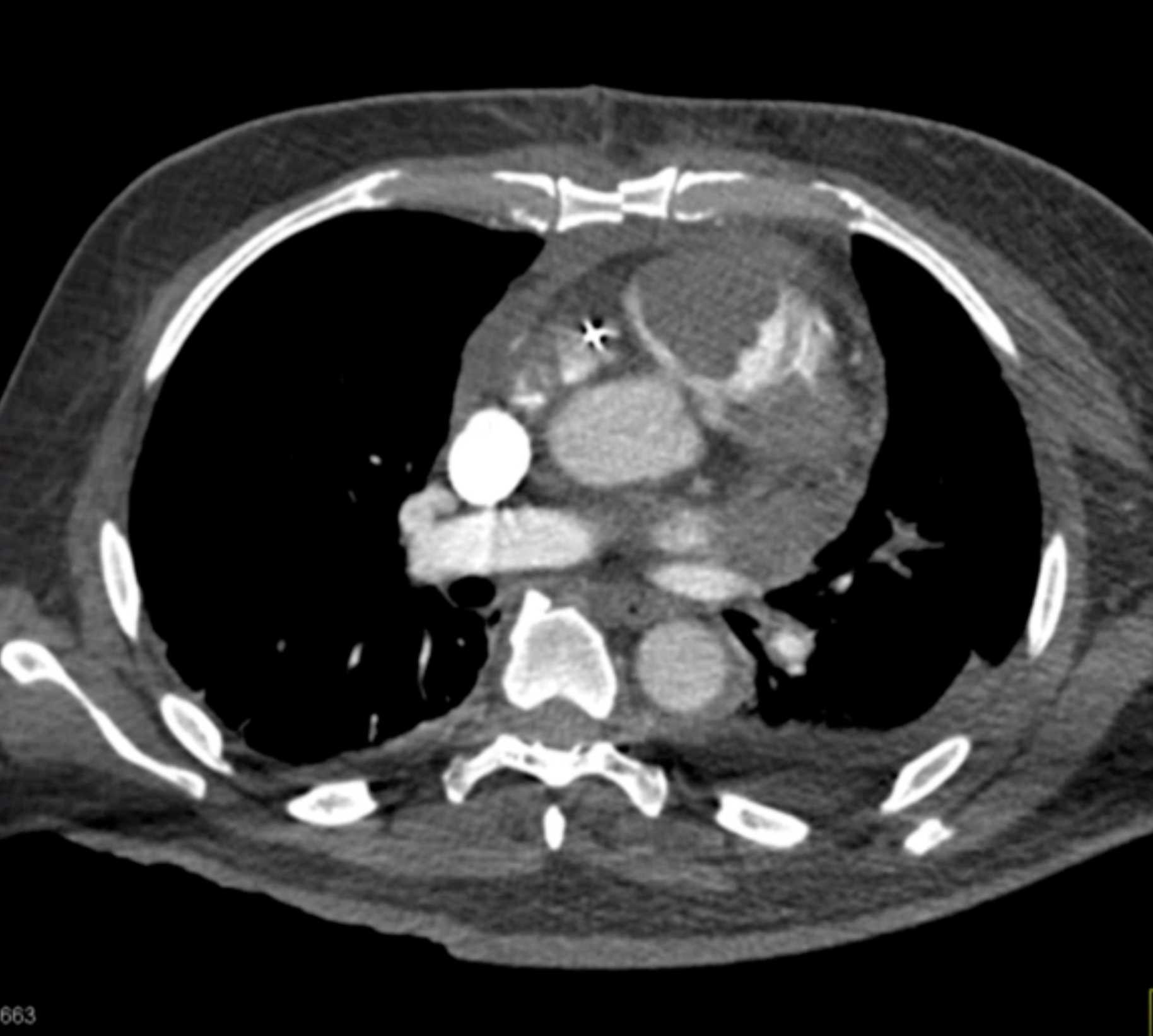 Primary Spindle Cell Carcinoma of the Right Ventricle - CTisus CT Scan
