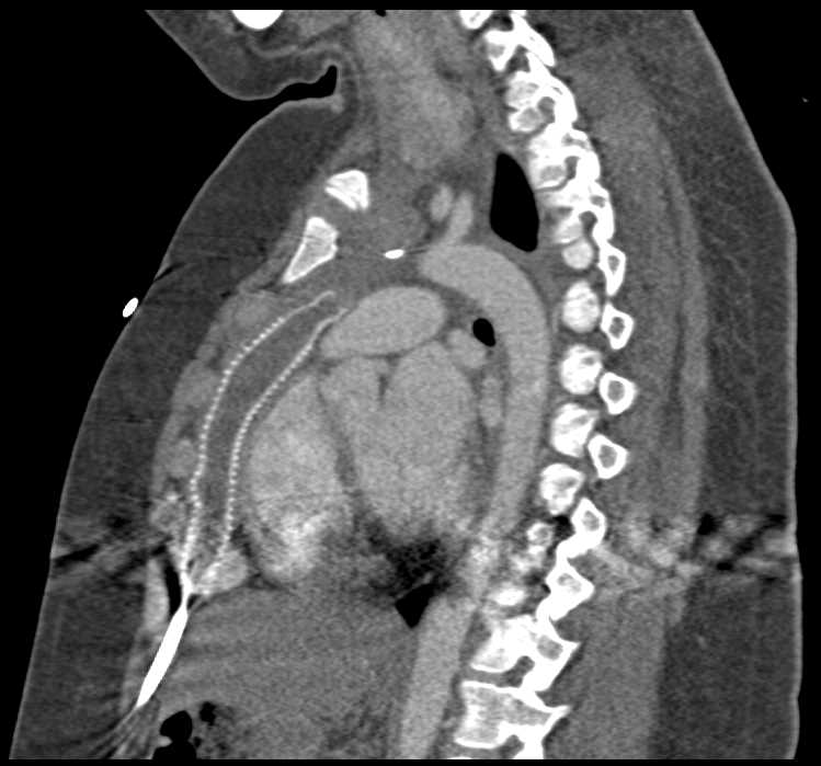 Cardiac Bypass Grafts - CTisus CT Scan