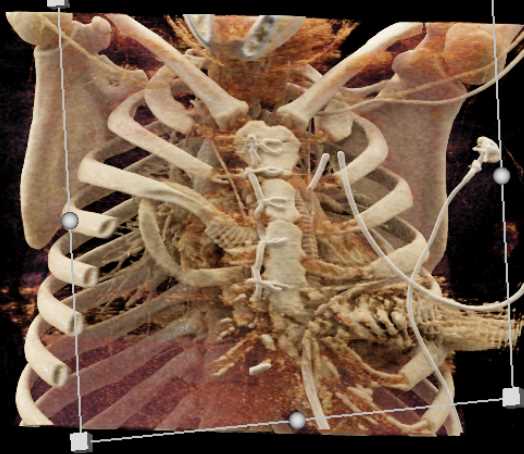 Cardiac Bypass Grafts - CTisus CT Scan