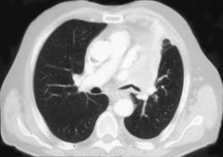 Left Upper Lung Collapse Due to Central Carcinoma - CTisus CT Scan