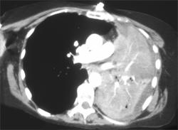 Lung Cancer Encases the Pulmonary Artery - CTisus CT Scan