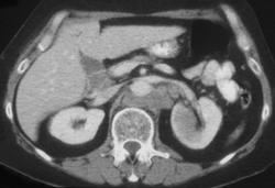 Lung Cancer With Axilla and Retroperitoneal Nodes, and Renal Metastases - CTisus CT Scan