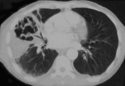 Lung Abscess - CTisus CT Scan