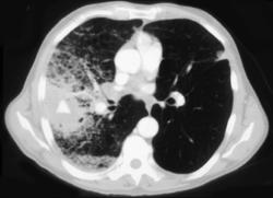 Lung Abscess With Pseudoaneurysm With Bleed - CTisus CT Scan