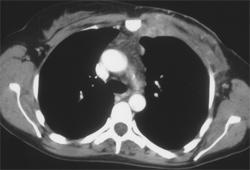 Lymphoma With Internal Mammary Nodes and Growth Through the Chest Wall - CTisus CT Scan