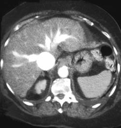 Congestive Heart Failure (CHF) - CTisus CT Scan