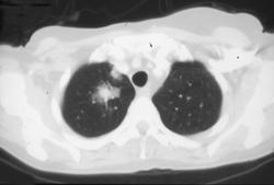 Choriocarcinoma With Hemorrhagic Metastases to the Lung - CTisus CT Scan