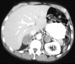 Lung Cancer (small Cell) With Adrenal Metastases - CTisus CT Scan