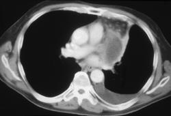 Lung Cancer Invades the Left Atrium - CTisus CT Scan