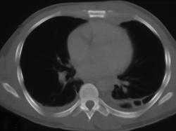 Chest Wall Abscess - CTisus CT Scan