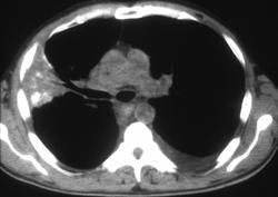 Collapsed Lung Due to Calcified Lung Cancer - CTisus CT Scan
