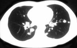Hodgkin's Disease Presenting With Lung Nodules - CTisus CT Scan