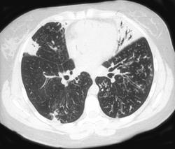 Bronchiectasis - CTisus CT Scan