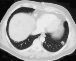 Colon Cancer With Cavitary Lung Metastases - CTisus CT Scan