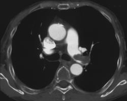 Pulmonary Embolism in A Patient With Lung Cancer - CTisus CT Scan