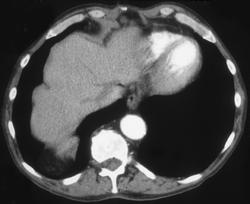 Bochdalek Hernia Simulates A Lung Mass - CTisus CT Scan