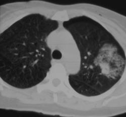 Bleed S/P Lung Bx - CTisus CT Scan