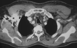 Jugular Vein Thrombosis in A Patient With Lung Cancer - CTisus CT Scan