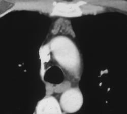Normal Thymus - CTisus CT Scan