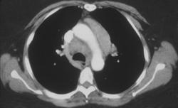 Lymphoma - CTisus CT Scan