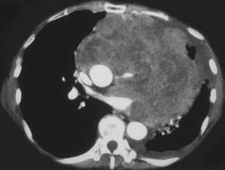 Lung Cancer Invades the Heart - CTisus CT Scan
