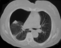 Pneumothorax S/P Lung Biopsy - CTisus CT Scan
