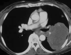Lung Cancer (NSCLC) - CTisus CT Scan