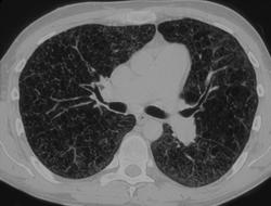 Graft versus Host Disease (GVH) of the Lung - CTisus CT Scan