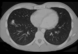 Wooden Foreign Body Simulates a PVM - CTisus CT Scan