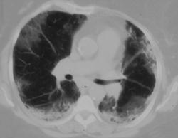 Unusual Lymphoma of the Lung - CTisus CT Scan
