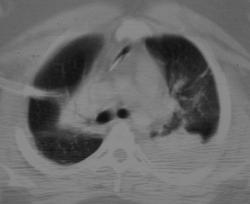 Chest Tube Extends Into Mediastinum - CTisus CT Scan