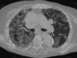 Rheumatoid Lung - CTisus CT Scan