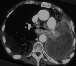 Lung Cancer Encases the Mediastinum - CTisus CT Scan