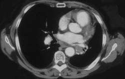 Recurrent Lung Cancer (Left Lower Lung) - CTisus CT Scan