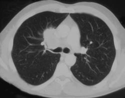 Lung Cancer (small Cell) - CTisus CT Scan