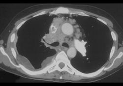 SVC Syndrome Due to Lung Cancer - CTisus CT Scan