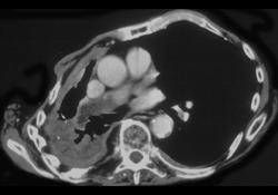 Pulmonary Embolism (PE) in Patient With Recurrent Lung Cancer - CTisus CT Scan