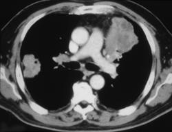 Left Upper Lobe Carcinoma With Metastases to Right Lung and Hilum - CTisus CT Scan
