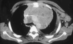 Cystic Hodgkin's Disease - CTisus CT Scan