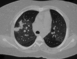 Takayasu's Arteritis - CTisus CT Scan